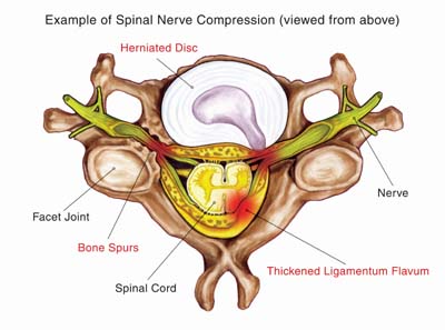 Nerve compression due to herniated disc may require ACDF