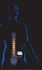 Why a Spinal Cord Stimulator May Be the Answer to Your Chronic