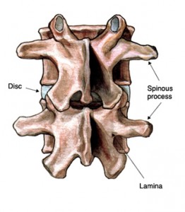 Degenerative Cervical Spine with Posterior Fusion